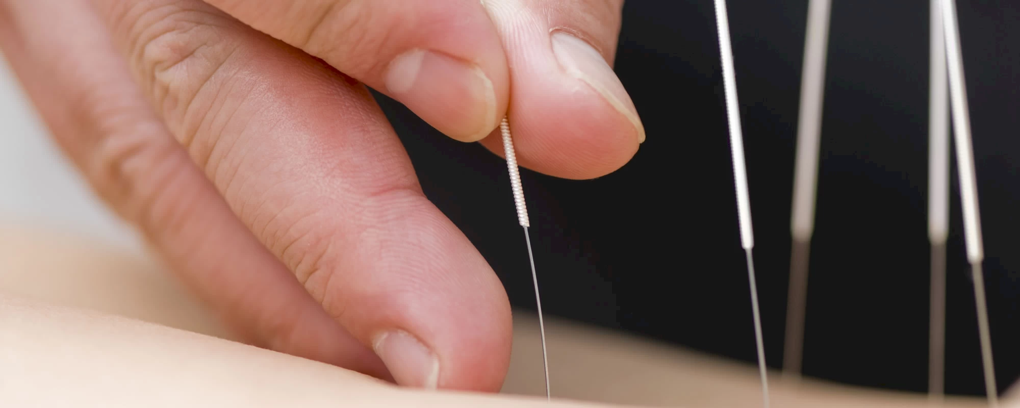 Acupuncture