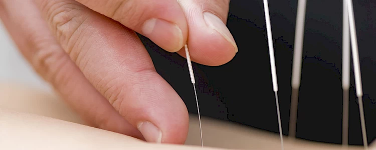 Photo of Acupuncture