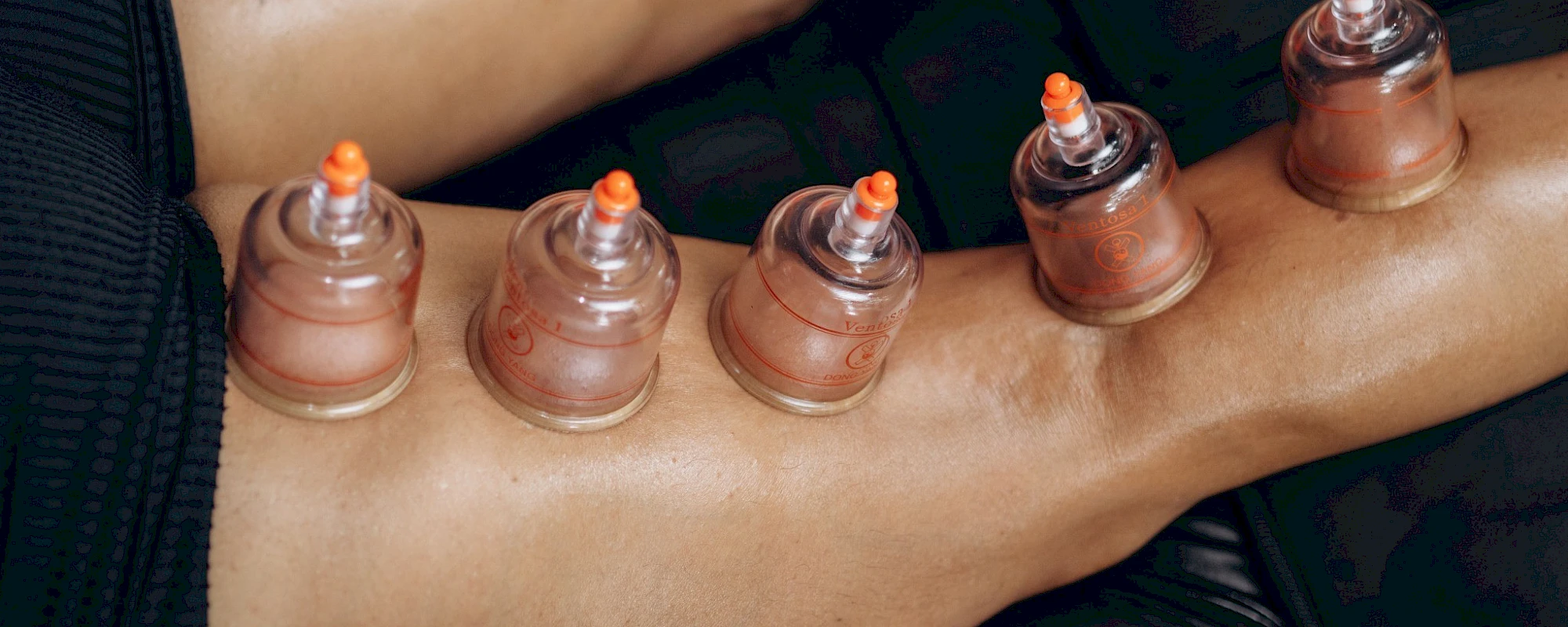 What Does Cupping Therapy Actually Do (And Why You Should Try It)